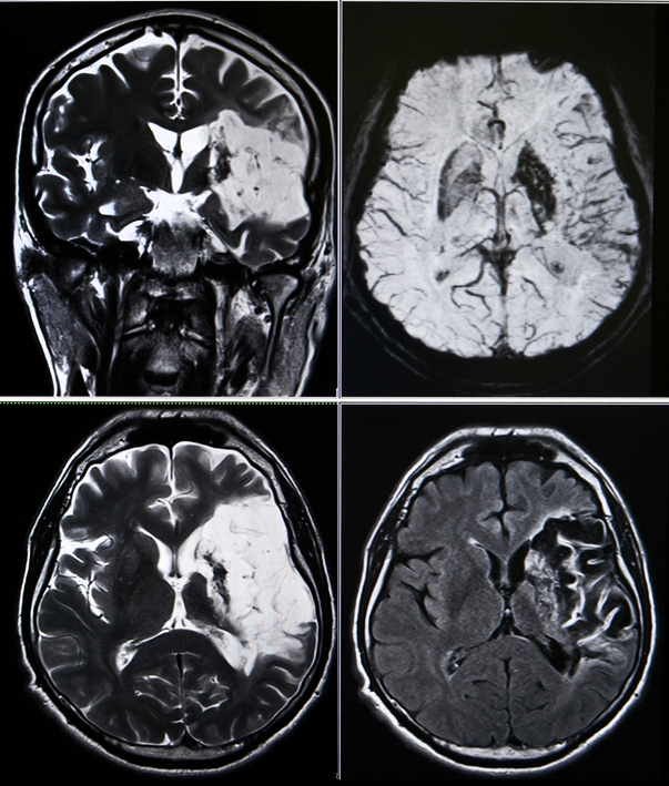 Brain stroke - MRI